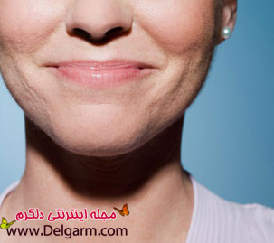 ترک خوردگی لب ها