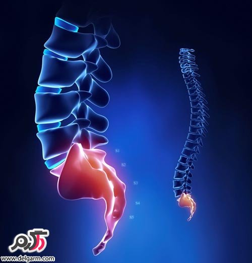 درمان آسیب دیدگی دنبالچه