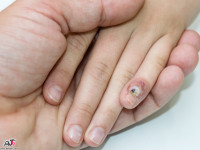 همه چیز در مورد ویروس پاپیلوم hpv اچ پی وی