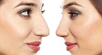 ریسک جراحی بینی و انواع روش های مختلف عمل زیبایی بینی