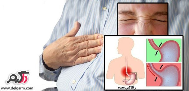 دلایل ترش کردن معده+درمان