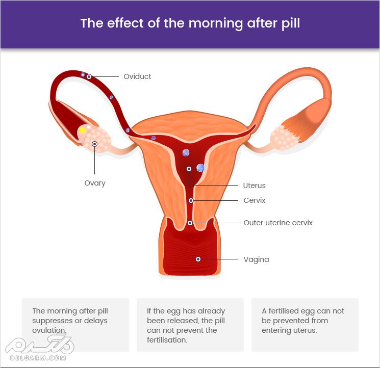 How does the morning after pill work ؟