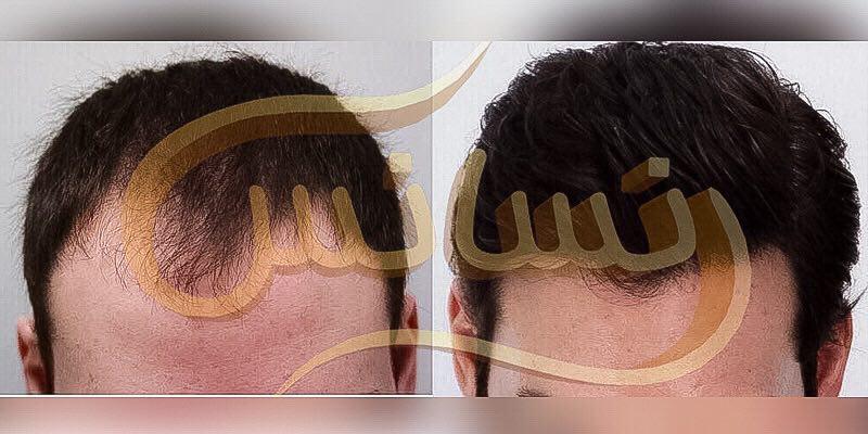 کاشت مو و ترمیم مو چیست ؟
