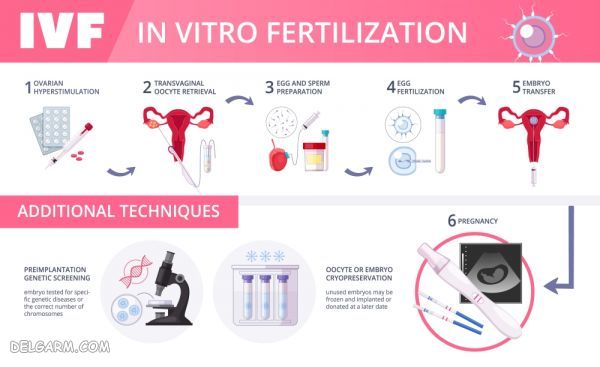 لقاح مصنوعی یا آزمایشگاهی (IVF)