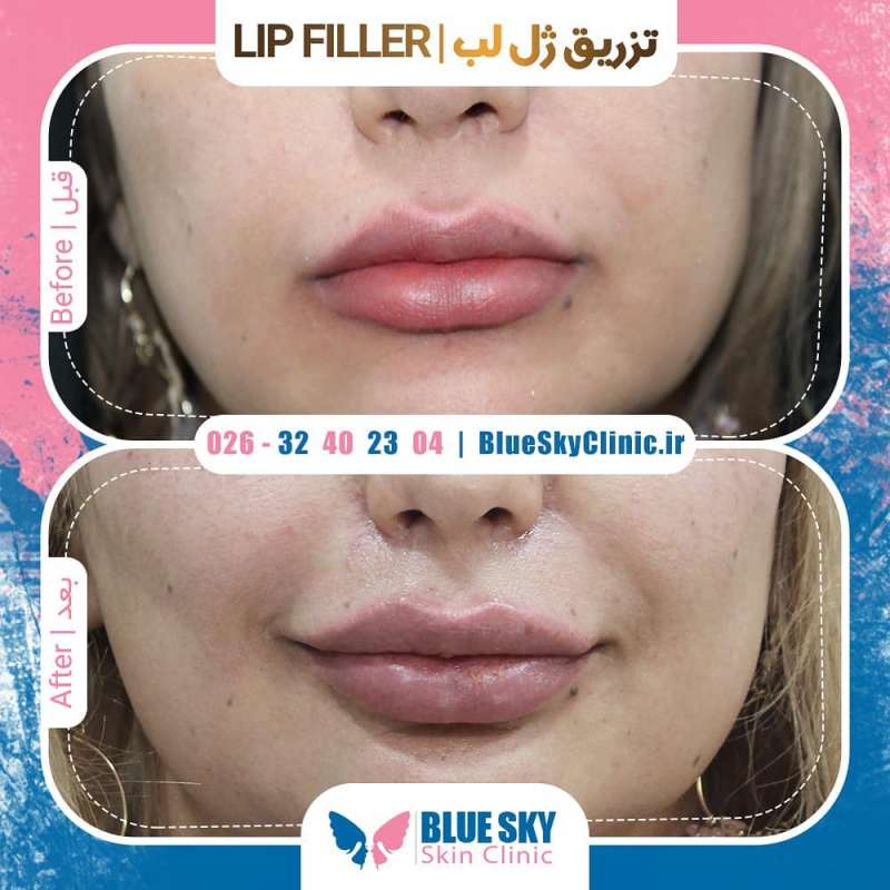 جراحی پلک و تزریق ژل در کلینیک آسمان آبی