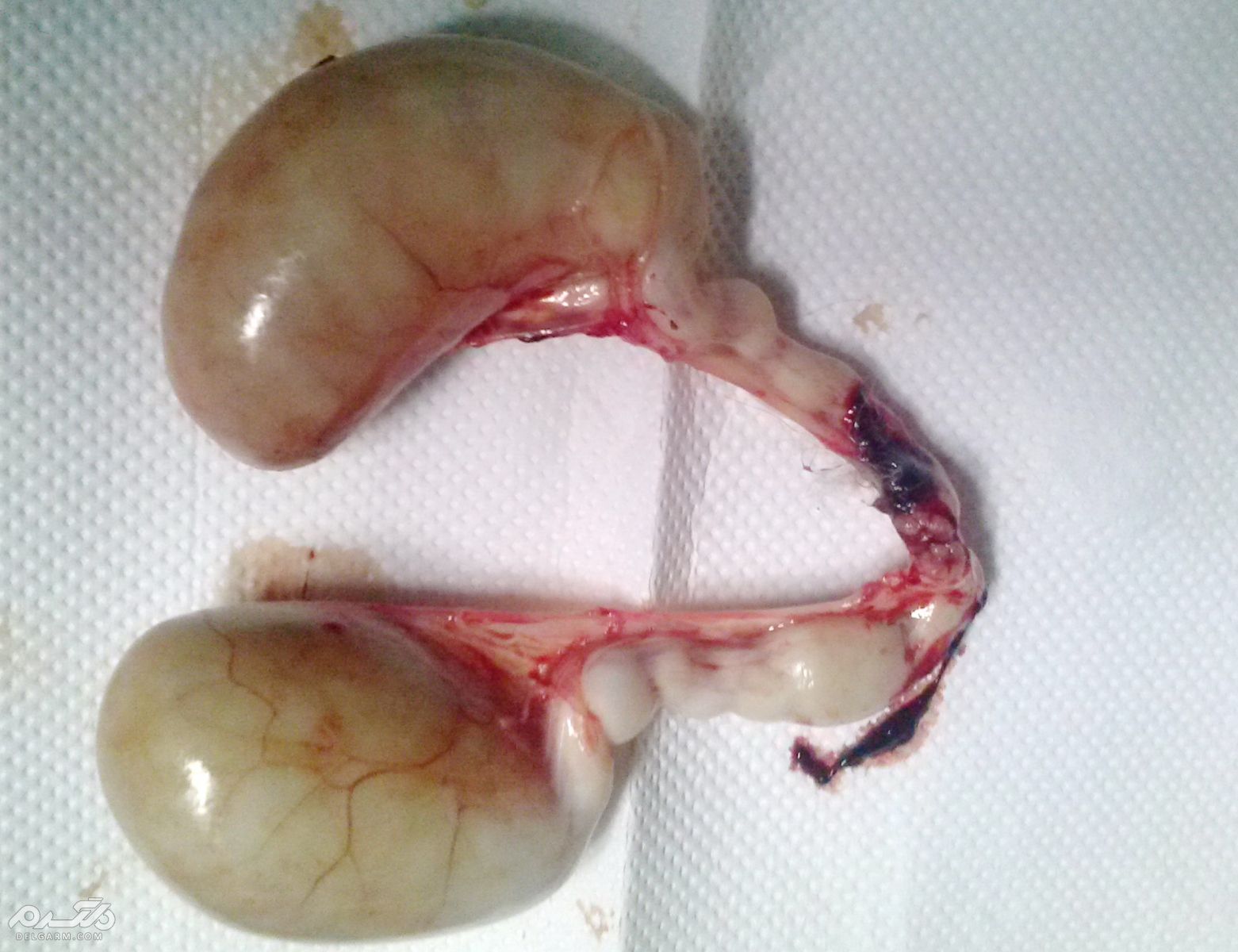 کیست تخمدان
