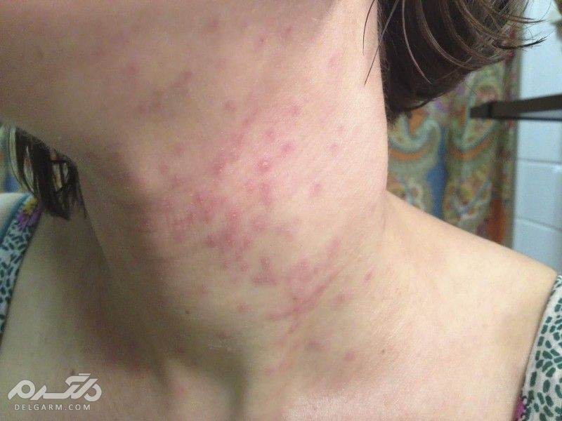 Pimples on the neck