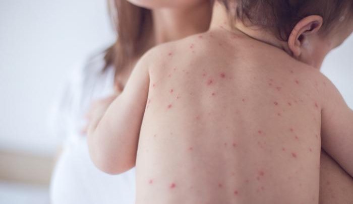 بیماری کورک چیست و چه علائمی دارد؟