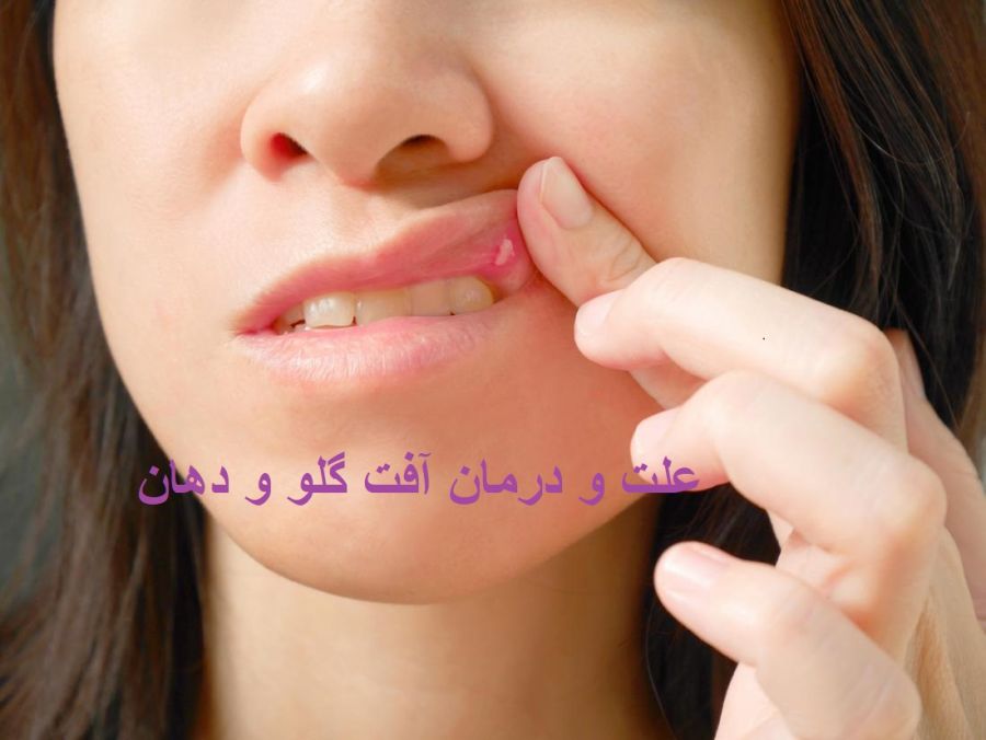 مناسبترین راه درمان آفت گلو