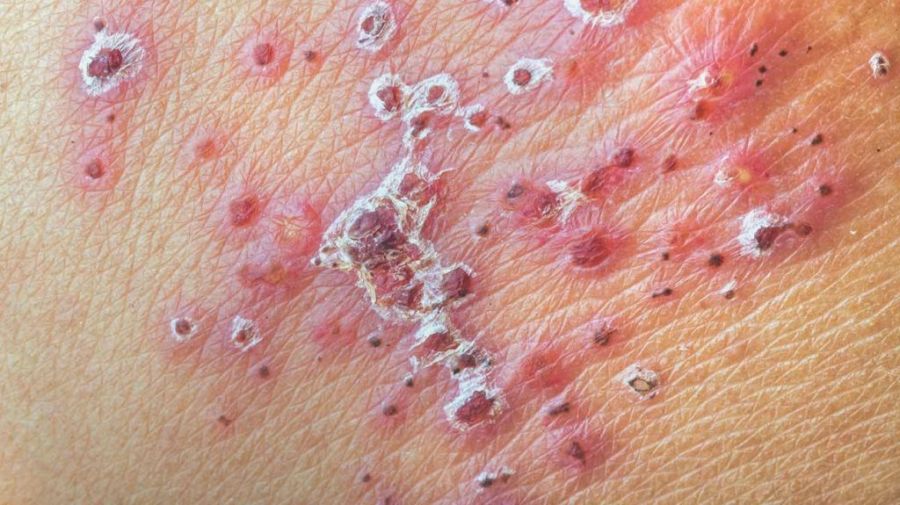 آبله مرغان چه خطراتی برای زنان باردار دارد؟