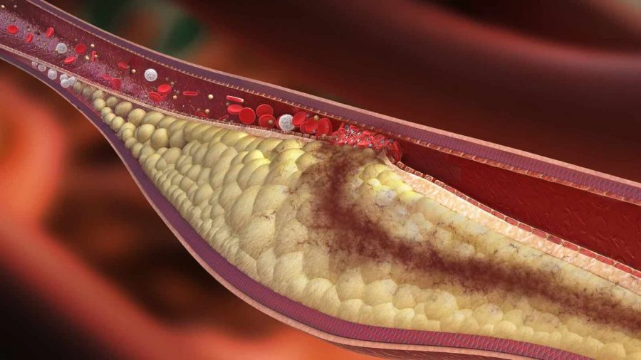 از خطرات بالا بودن چربی خون چه میدانید؟
