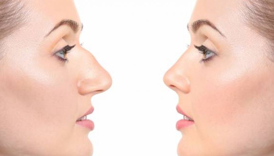 پاسخ به سوالات رایج درباره عمل بینی