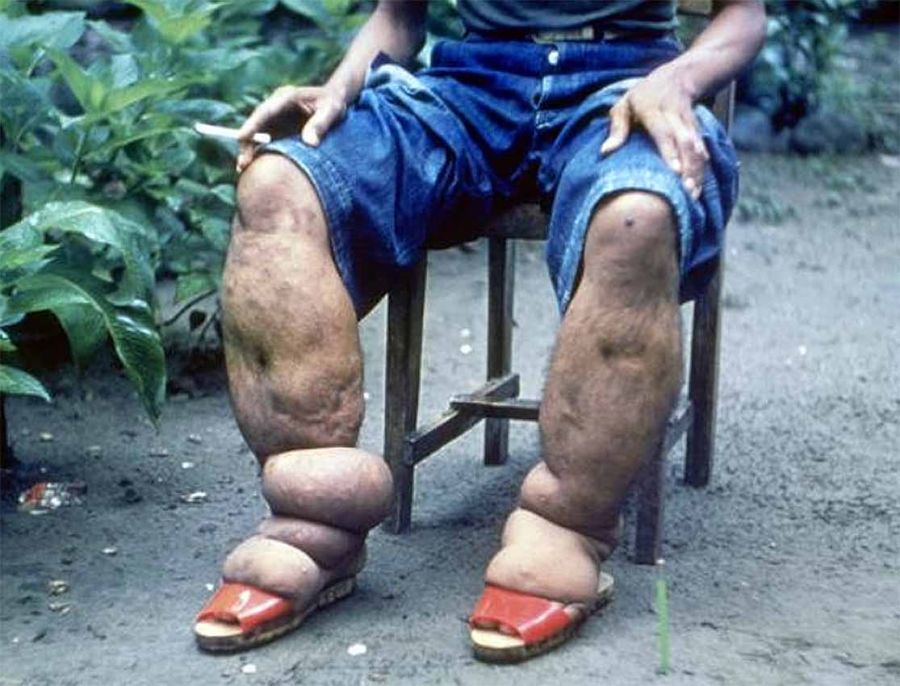 همه چیز در مورد بیماری فیلاریازیس لنفاوی (Lymphatic Filariasis)