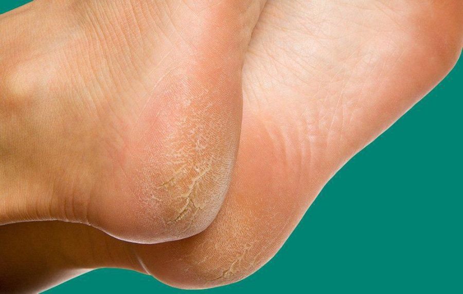درمان پوسته پوسته شدن پاشنه پا به روش های طبیعی و ساده