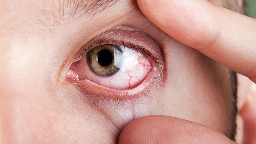 مهمترین علل احساس وجود چیزی در چشم