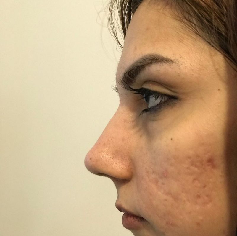 ماندگاری پلاسما جت (پی آر پی) بینی و صورت چقدر است؟