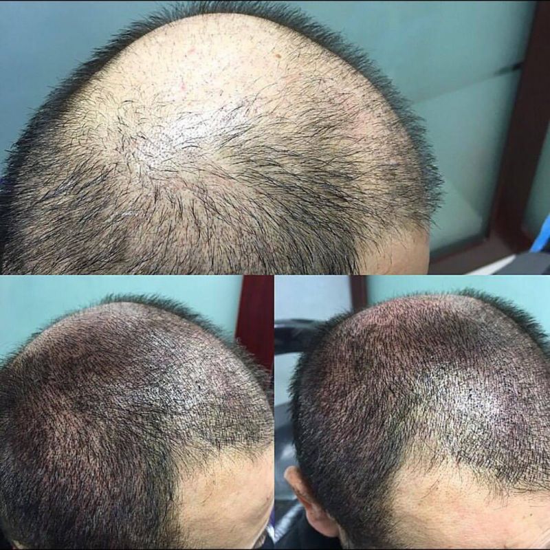عوارض اسکالپ سر چیست؟! معایب میکرو اسکالپ