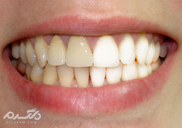 5 مزیت باور نکردنی میخک برای دندان لثه و دهان