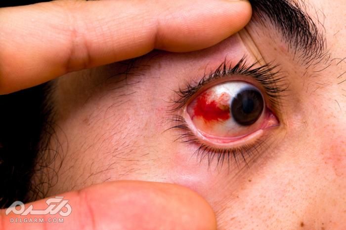 از علت تا درمان قرمزی چشم ویروس شدن چشم عفونت چشم