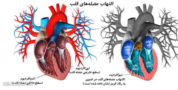 میوکاردیت التهاب عضله قلب
