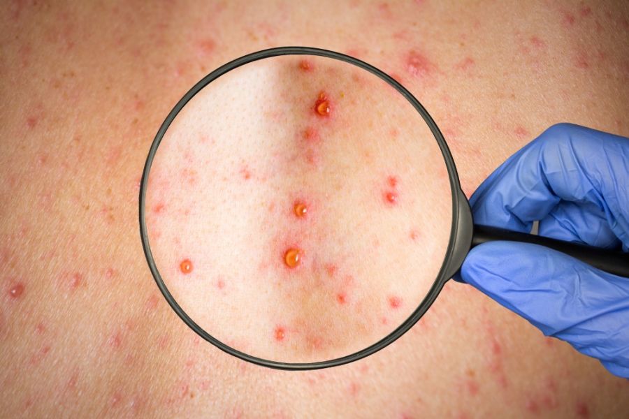 خطرات سرخجه در بارداری چیست و چگونه درمان میشود ؟