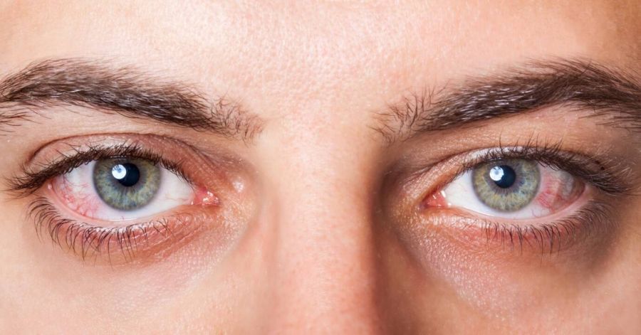 سکته چشمی چیست ؟ بررسی علل،علائم و درمان این عارضه