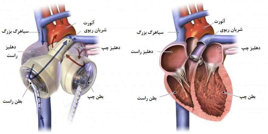 پیوند قلب مصنوعی : قلب مصنوعی چگونه کار میکند ؟
