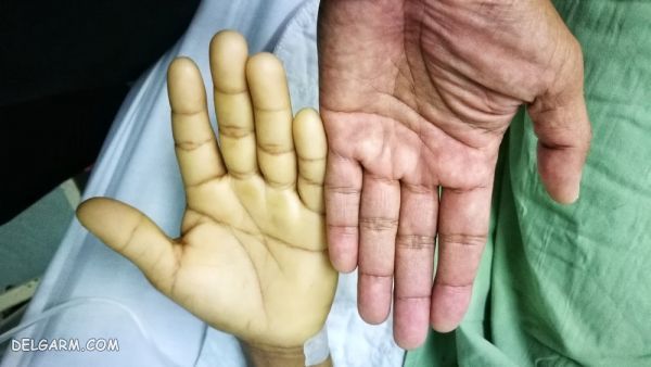 / علائم کم خونی در زنان / علائم کم خونی در مردان / علائم کم خونی در کودکان/ نشانه های کم خونی / علائم کم خونی