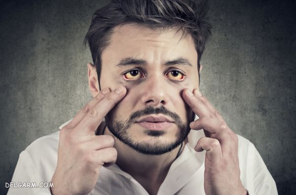 / علائم کم خونی در زنان / علائم کم خونی در مردان / علائم کم خونی در کودکان/ نشانه های کم خونی / علائم کم خونی