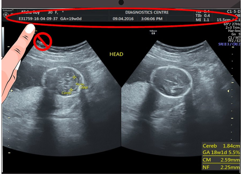 تفسیر برگه سونوگرافی بارداری به صورت تصویری و مرحله به مرحله