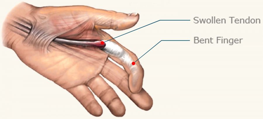 انگشت ماشه ای (trigger finger) چیست و چگونه درمان میشود ؟