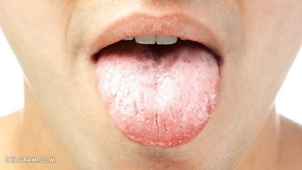 عوامل تشدید کننده بیماری برفک دهانی
