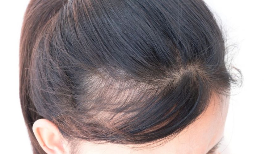 چگونه از پیاز برای درمان طاسی سر و ریزش مو استفاده کنم ؟