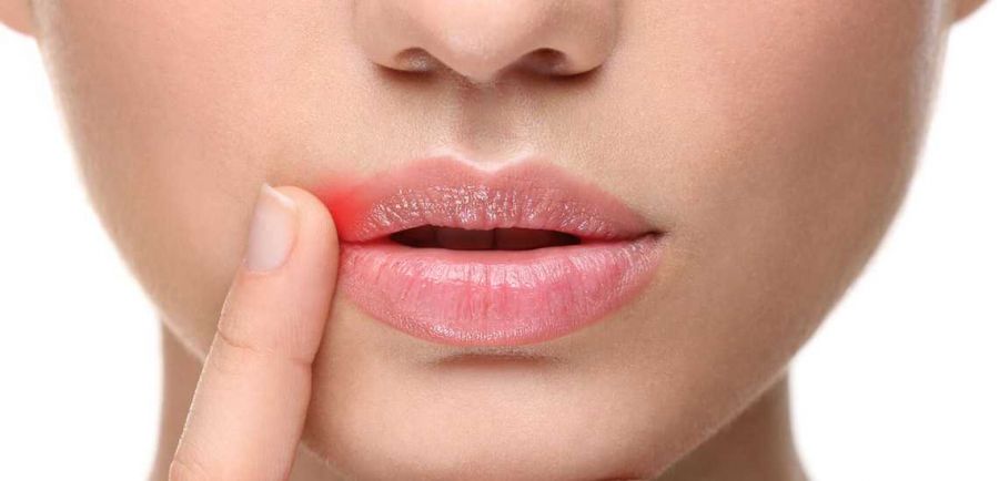علت ایجاد آفت دهان چیست ؟ چه عواملی باعث بروز آفت دهان میشوند ؟