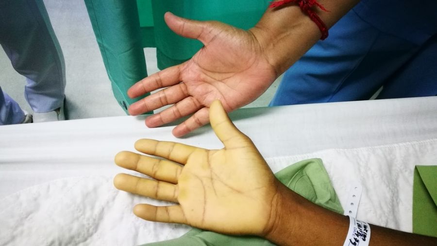 کمخونی ناشی از کمبود اسید فولیک چیست و چگونه درمان میشود ؟