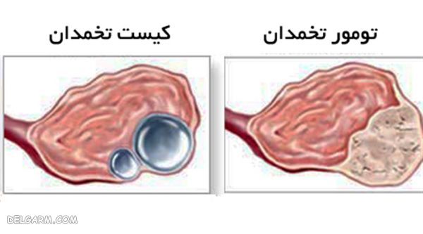 تفاوت بین تومور و کیست