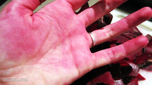 ۵ روش اساسی جهت پاک کردن لکه بادمجان و سبزیجات از روی پوست دست