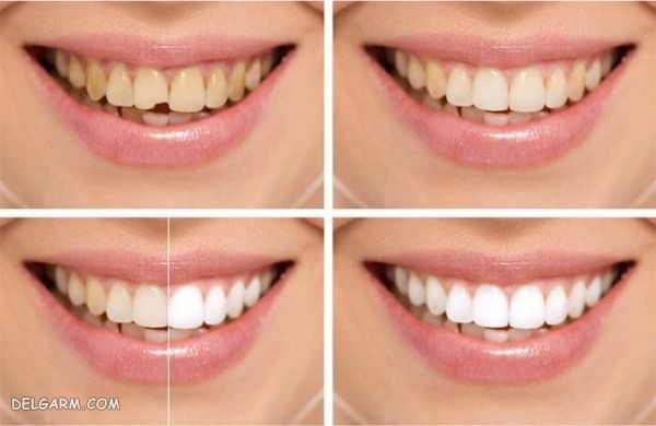  کامپوزیت یا لمینت دندان؟ کدام بهتره ؟