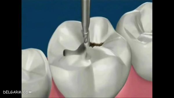 مراحل پر کردن دندان با ماده سفید