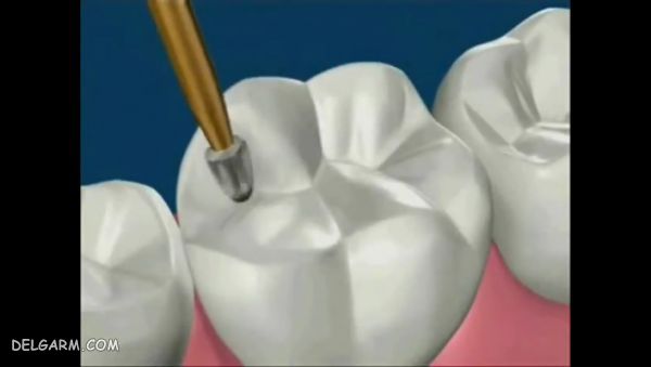 مراحل پر کردن دندان