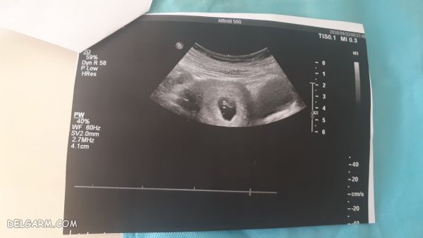 آزمایش های هفته هفتم بارداری