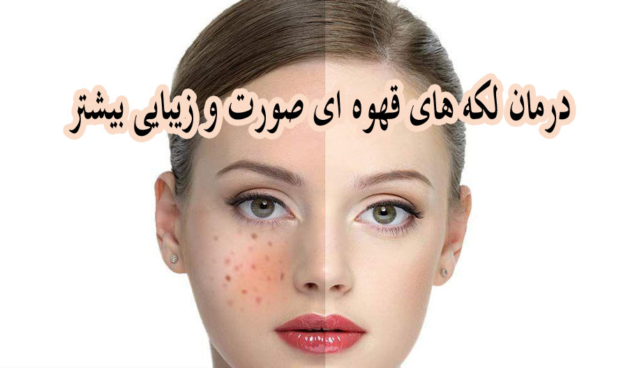 ۱۰ راهکار خانگی تاثیر گذار برای از بین بردن لکه های قهوه ای صورت