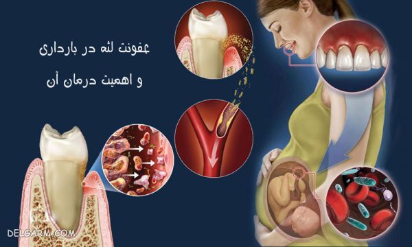  / علت عفونت لثه در بارداری / علت درد دندان در بارداری / عفونت لثه در بارداری / درمان عفونت لثه / جلوگیری از عفونت لثه / دندان درد در بارداری
