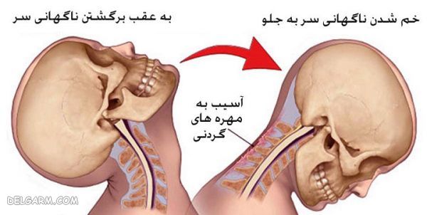 گردن درد