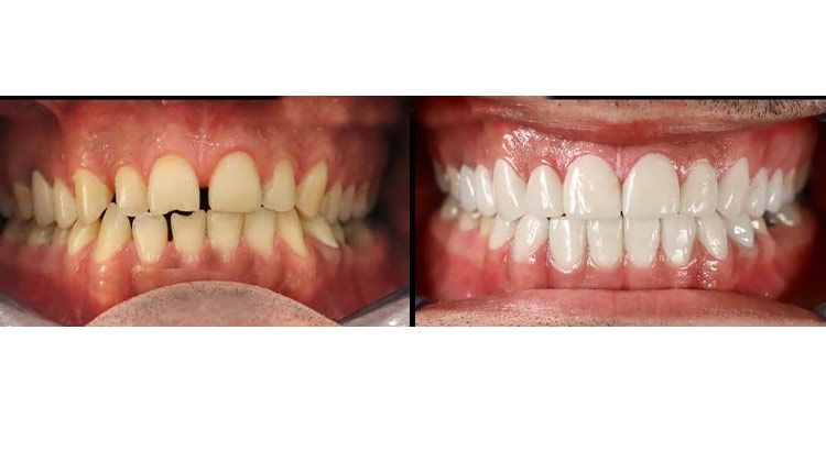 قبل و بعد از تغییر دندان ها با ایمپلنت