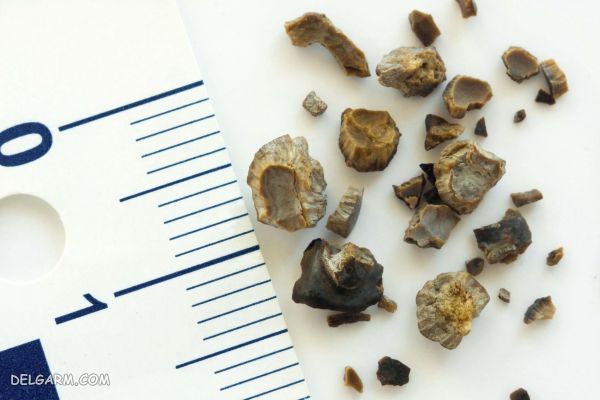 سنگ کلیه و آشنایی با مواد غذایی مفید و غیرمفید برای آن سنگ کلیه و آشنایی با مواد غذایی مفید و غیرمفید برای آن