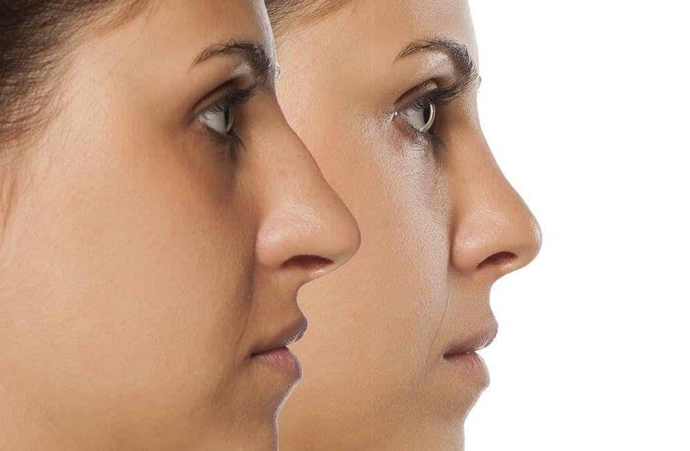 چرا لیفت بینی جایگزین مناسبی برای جراحی بینی میباشد؟