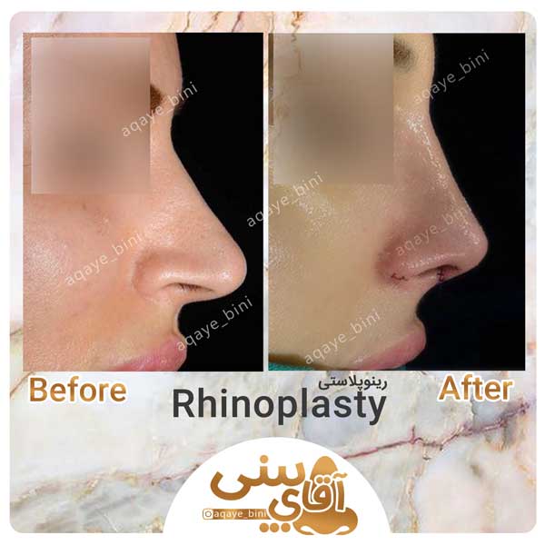 جراحی بینی را برای چه باید انجام بدیم و باید چه نکاتی رو لحاظ کنیم ؟
