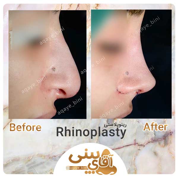 جراحی بینی را برای چه باید انجام بدیم و باید چه نکاتی رو لحاظ کنیم ؟