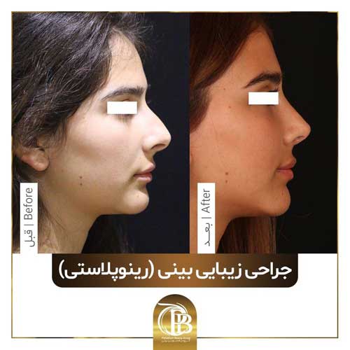 جراحی بینی را برای چه باید انجام بدیم و باید چه نکاتی رو لحاظ کنیم ؟